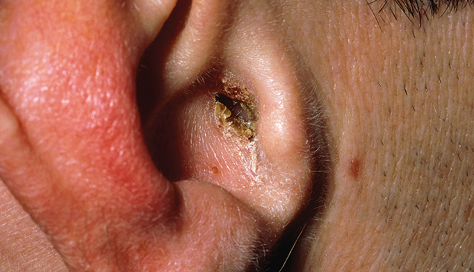 close-up of inner ear buildup